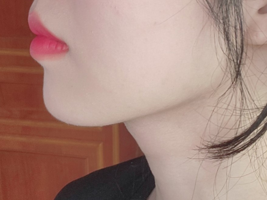 이중턱 지방흡입 후 살 빠졌냐는 소리 들어요 ㅎㅎ