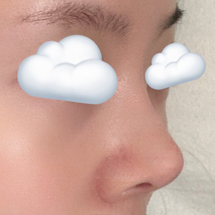 코수술 만족합니당