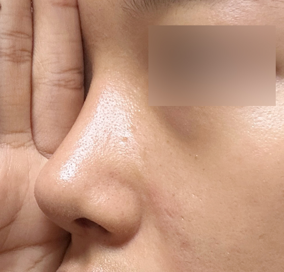 복코성형 맛집은 바이브에용 ㅎㅎ