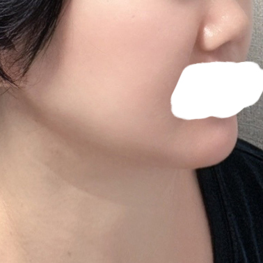 처진살들 교정 갸름해져 만족스럽습니다 ^^