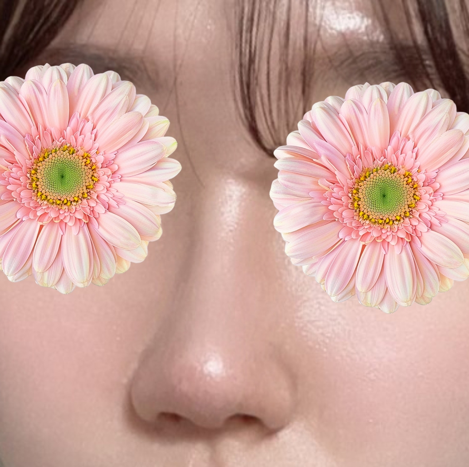 코수술 후회 없어요 !