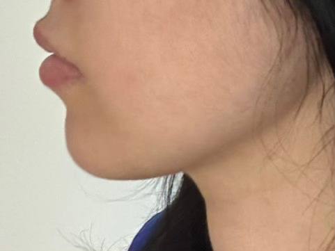 바이브성형외과 추천드립니당