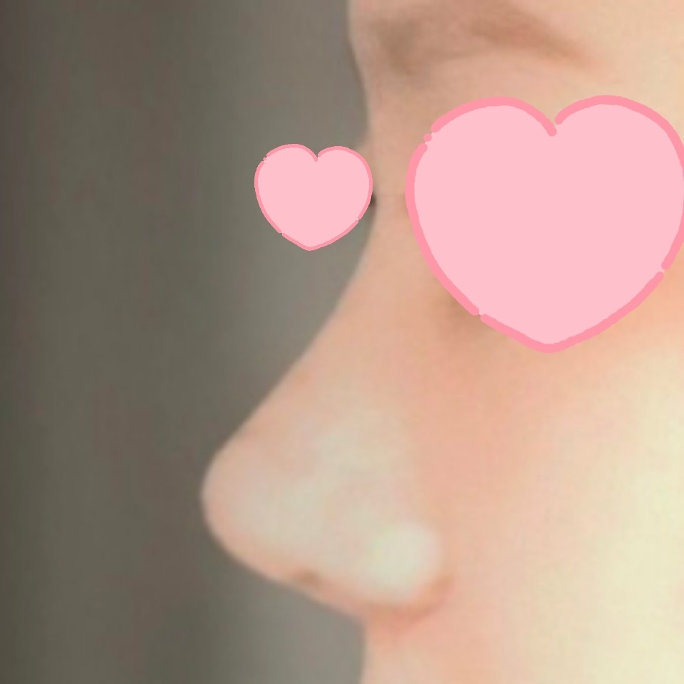 코수술 후 10년은 젊어보여요