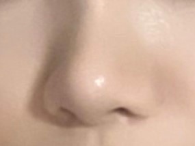 비공내리기 수술 정말 만족해용ㅎㅎ