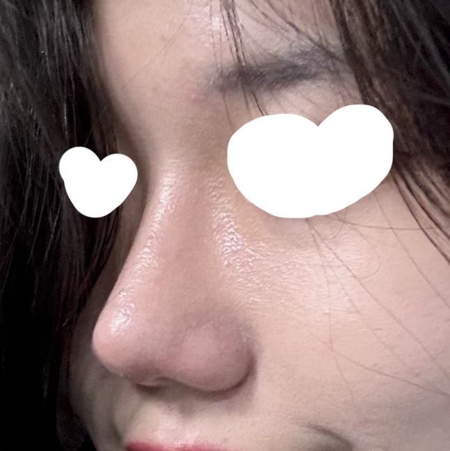 절개눈매교정, 첫코성형 후기에용ㅎㅎ