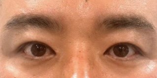 눈수술 6개월차 후기 입니다 ^^