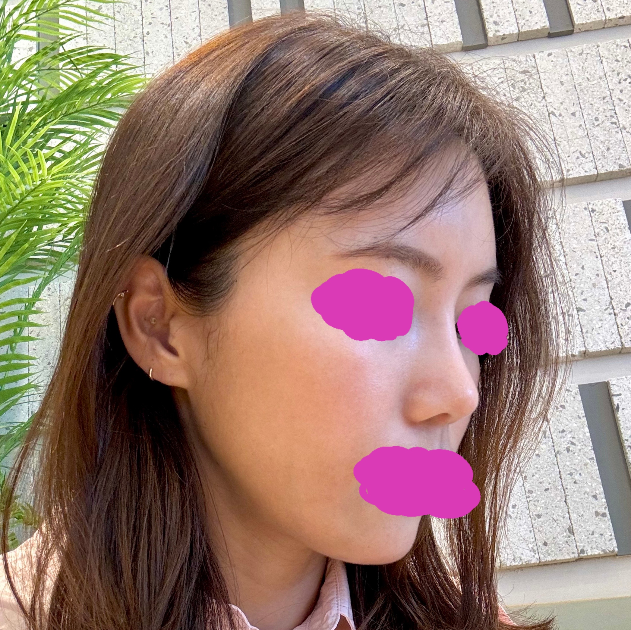 수술 3개월차가 되었네요 고민한 시간이 아까워요 !