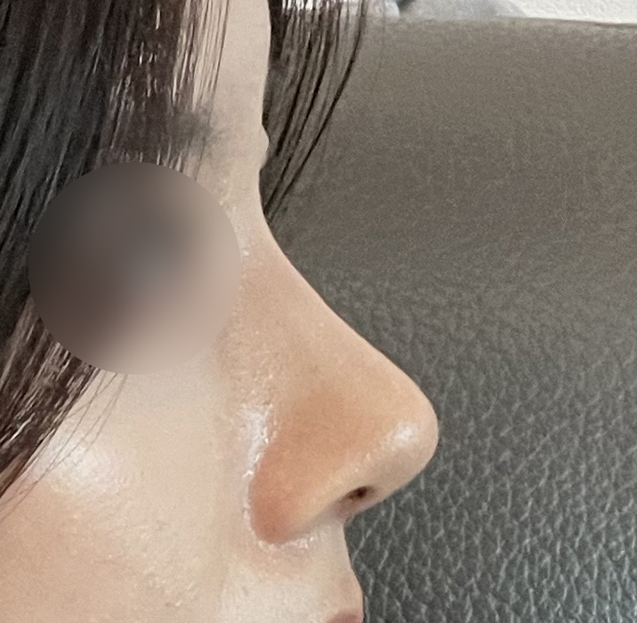 매부리코&복코성형 1개월차:)