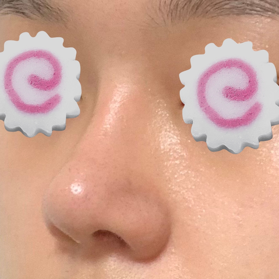 코수술 후 너무 만족해요 !