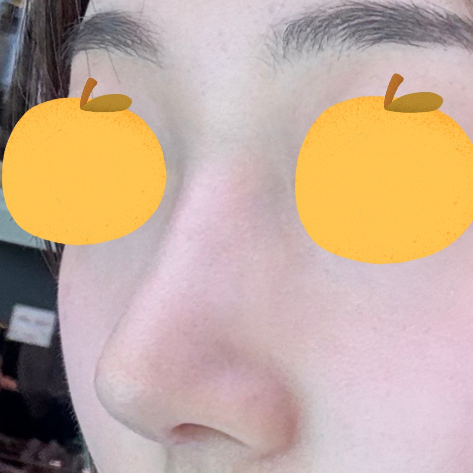 원장님 덕분에 매부리코 개선됐어요!