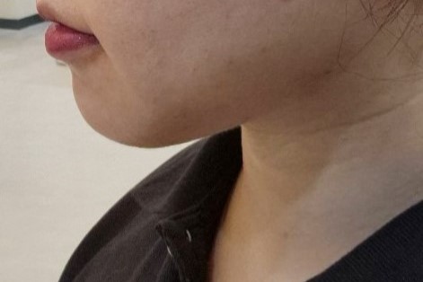 이중턱 삭제 시켜주셔서 감사합니다 ㅠ!!