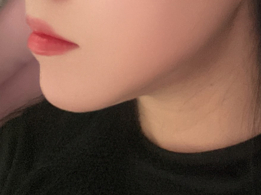 지방흡입 1개월차 기대 이상입니다 !!