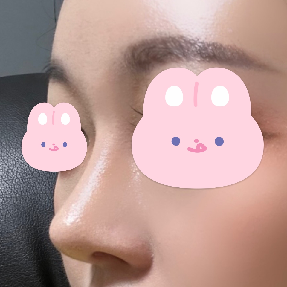 수술 후 거울보는 맛이 즐거워요