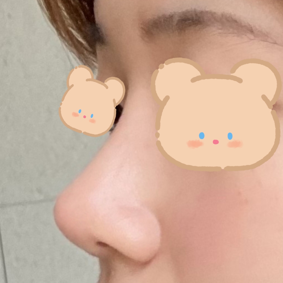 코성형, 심부볼 지방제거 6개월차 후기 입니다