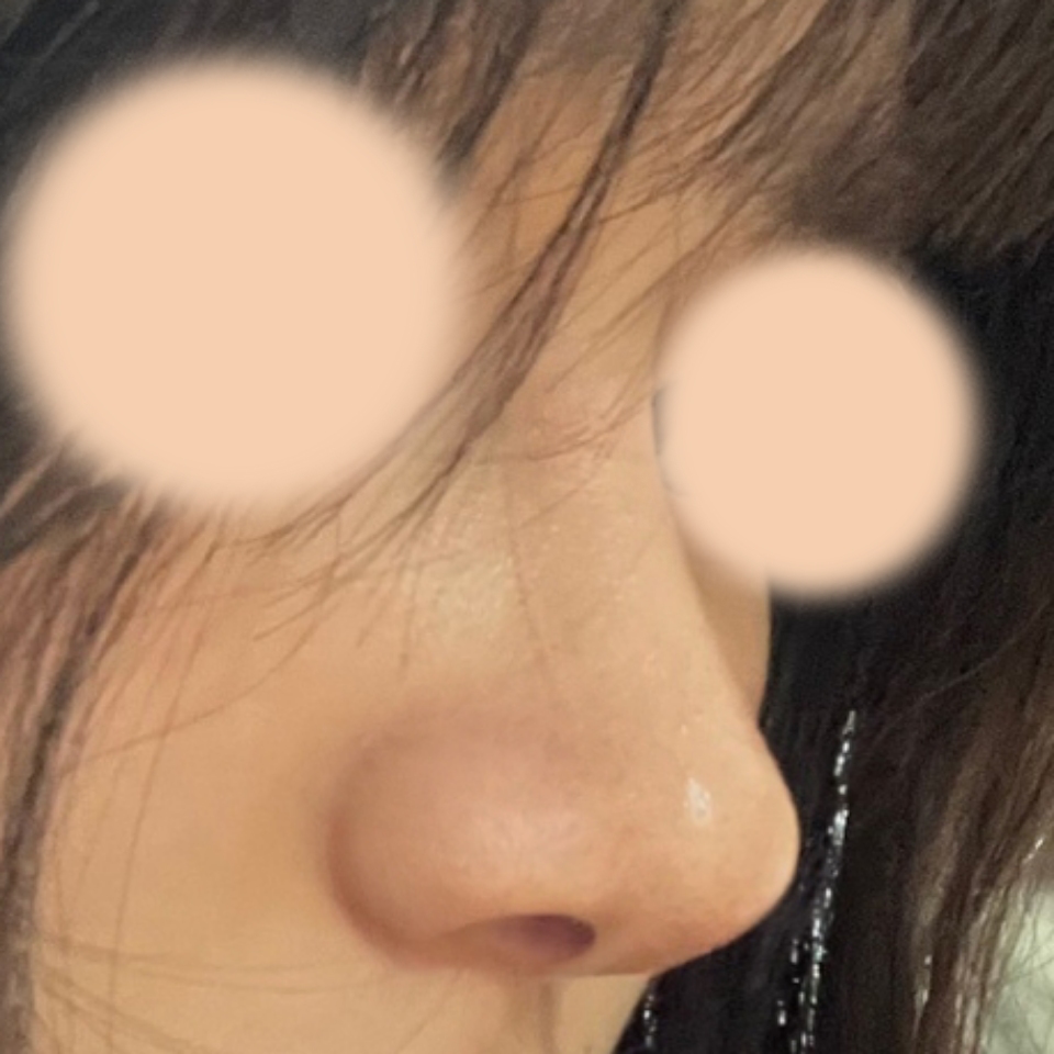 코가 예쁘게 자리 잘 잡아서 너무 만족중이에요 ㅎㅎ