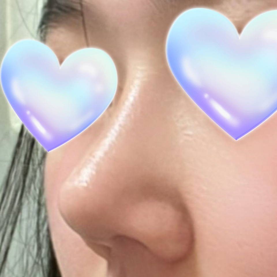 코수술 후 만족하면서 지내고 있습니다