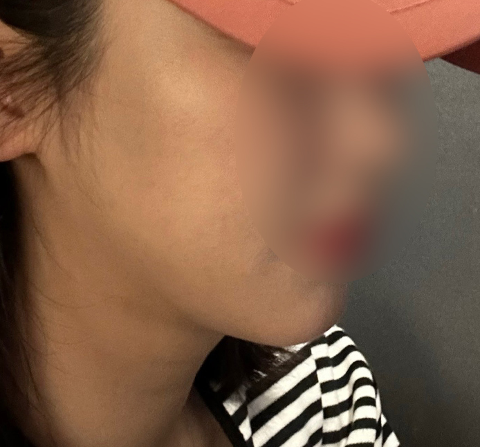 얼굴지방흡입 매우 잘됐습니당