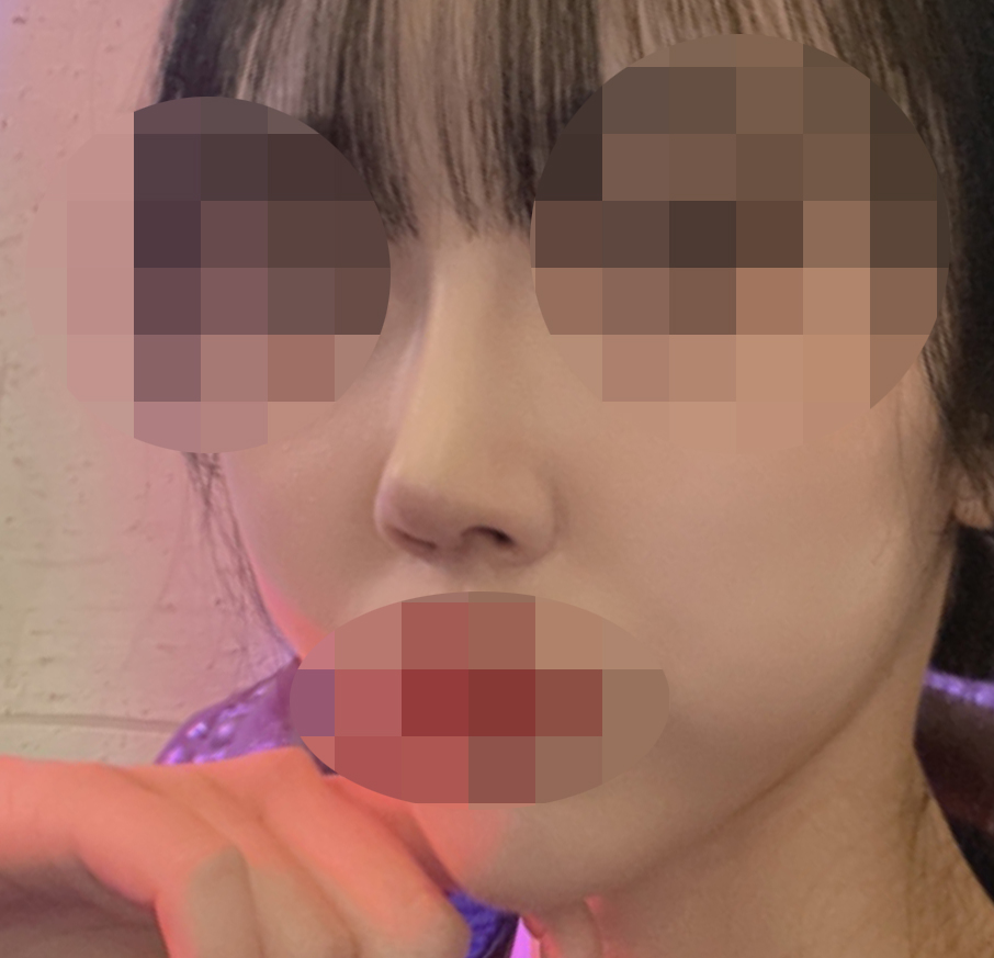 4년고민끝에 코수술결정!후회없어요ㅎㅎ