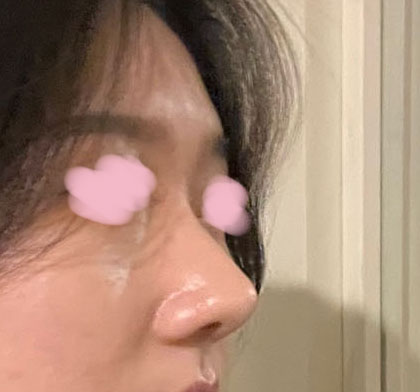 무보형물코성형 자연스러워요!