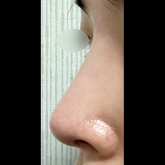 바이브 코성형 굉장히 만족스러워요