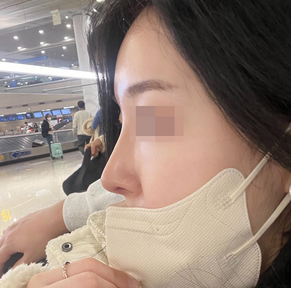 무보형물코수술 만족중~!