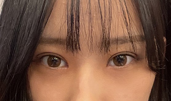 부분절개,앞트임,눈매교정한지 2주차