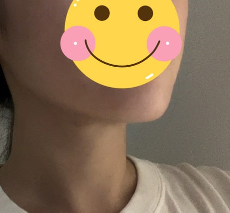 이중턱 해결했네요 ㅎㅎㅎ