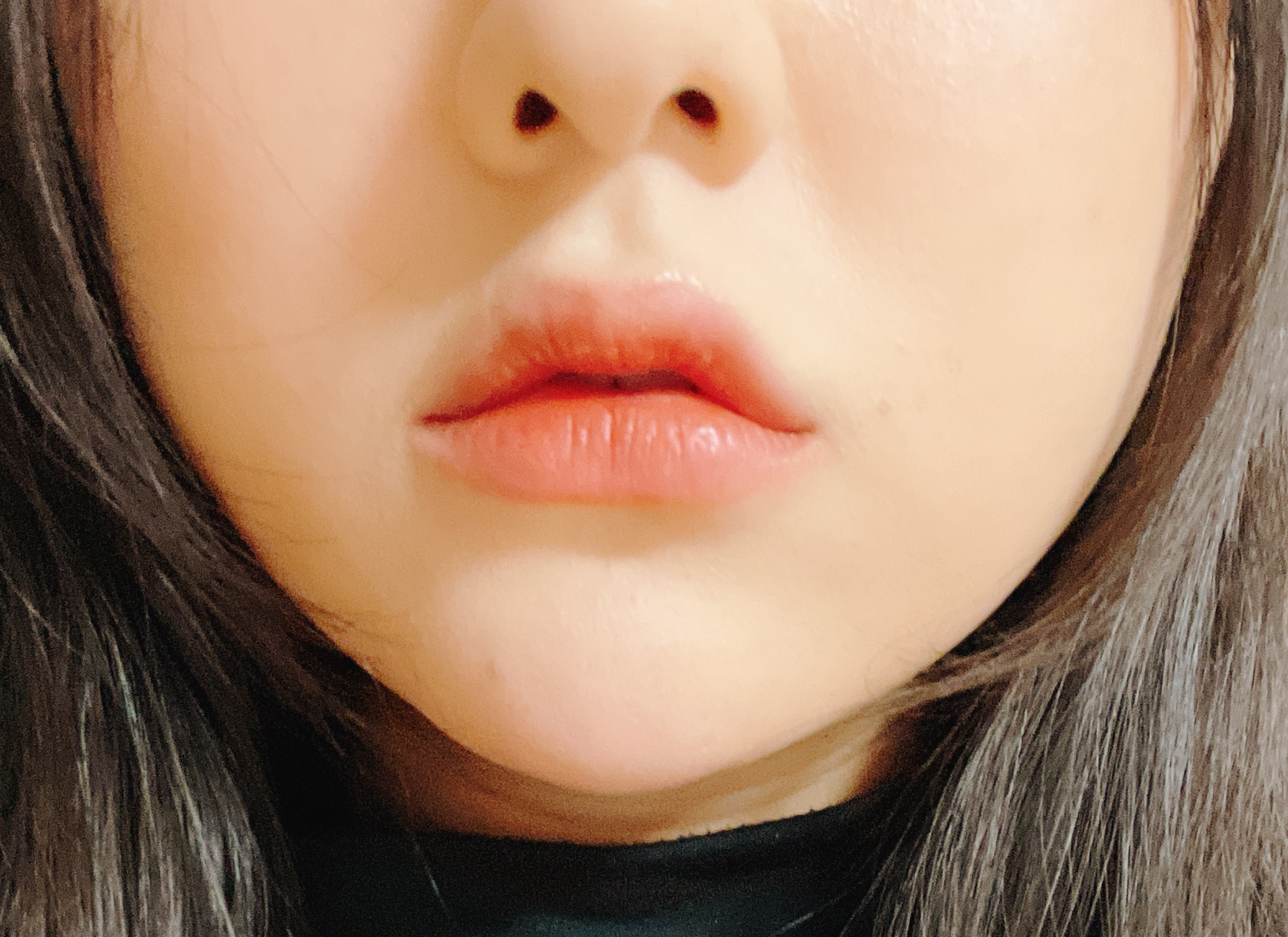 이중턱 지방흡입 + 입술필러