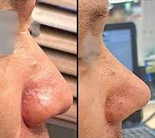 중년코수술 4개월이 지나갑니다..