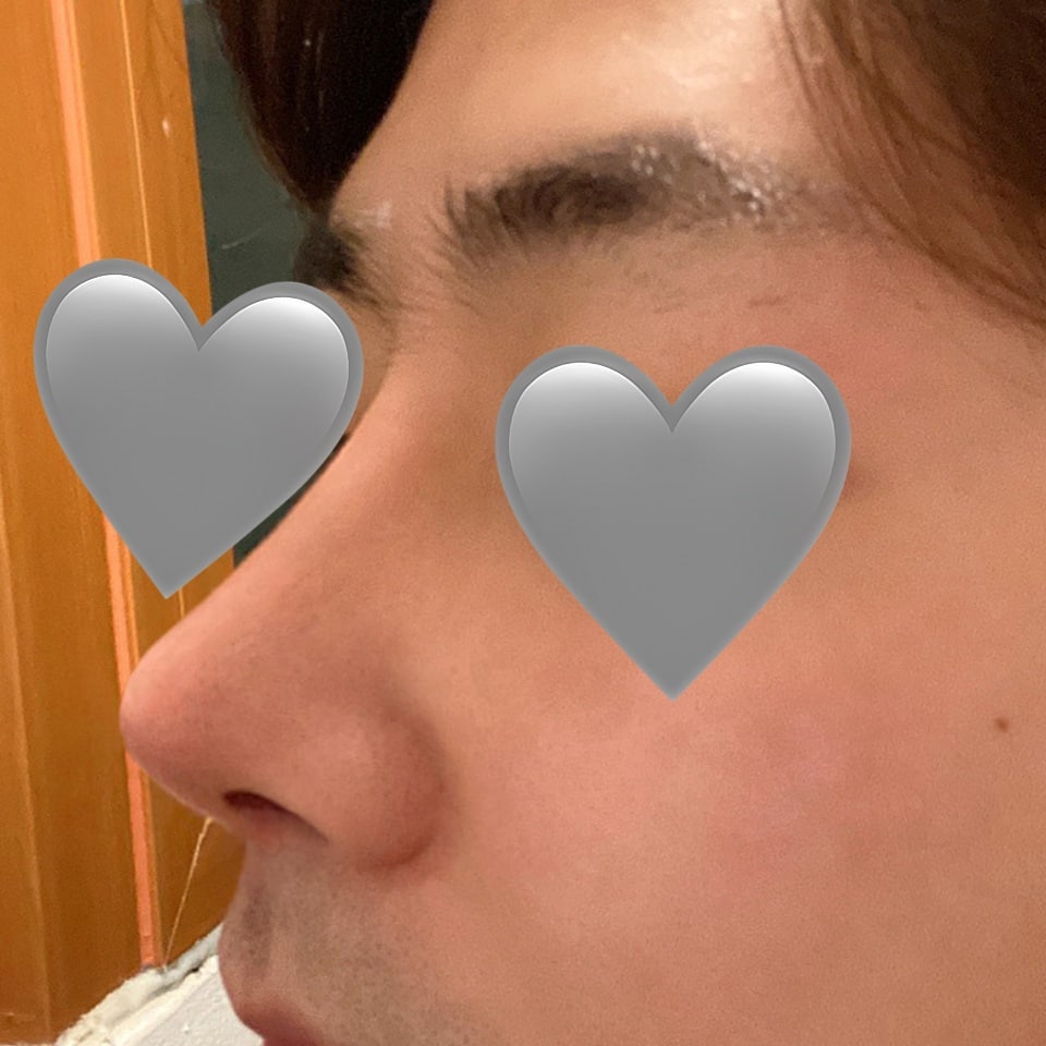 남자코성형 콧대+코끝 3주차^^