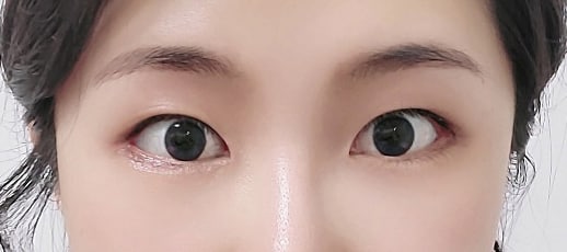 트임수술 했어요~~