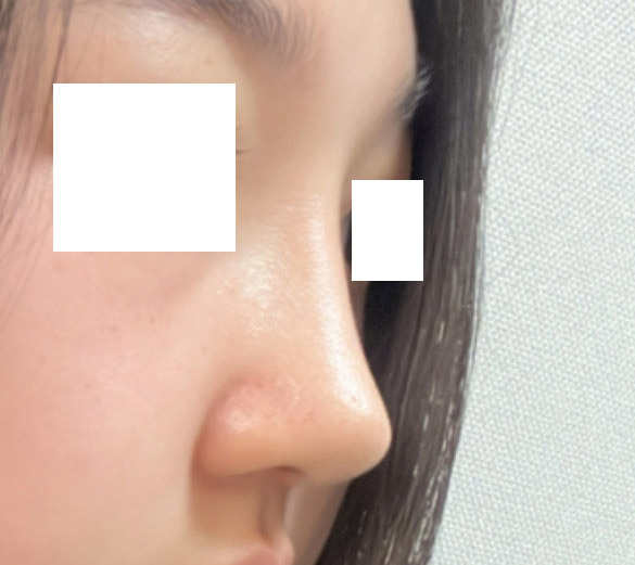 코성형1달차! 너무 잘된거같아용:)