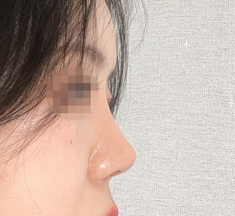 구축때문에 코재수술했어요