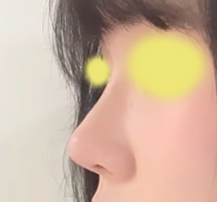 기능코성형한지 세달넘어가욤