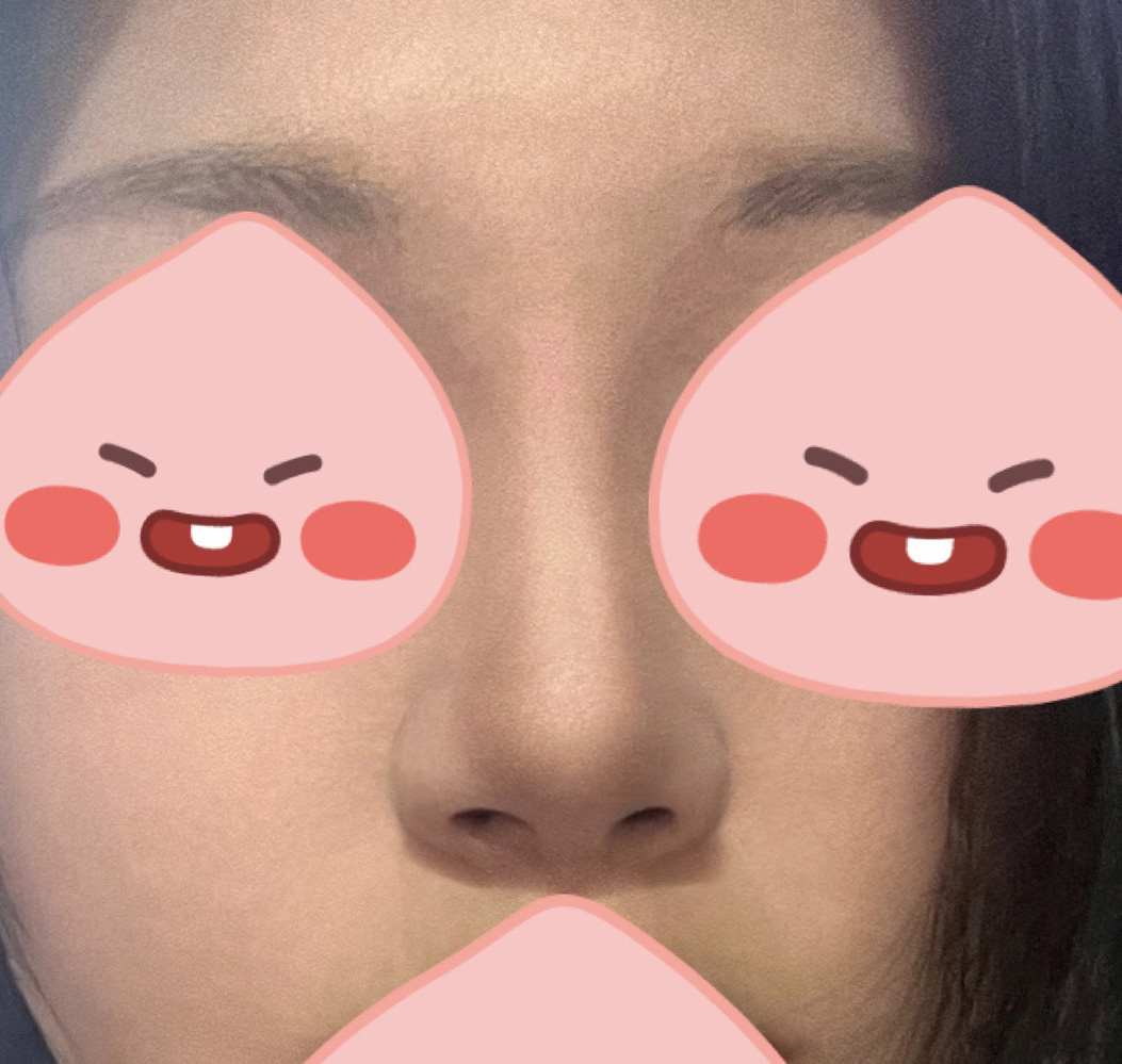 코수술3개월차됐는데 괜찮나요~!?