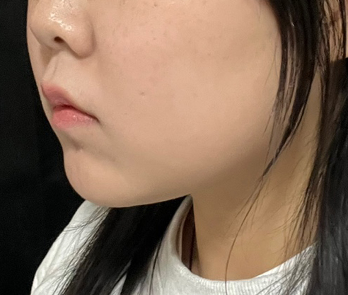 이중턱지방흡입 완죤 만족!!