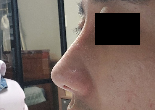 남자 눈코수술후기!!자연스러워요