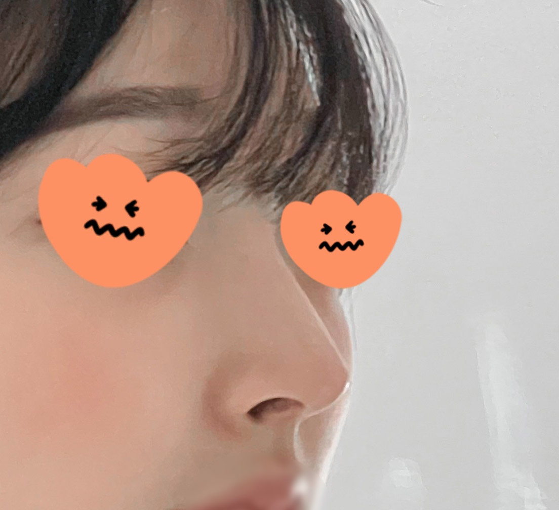 매부리코성형한지 반년넘었어용