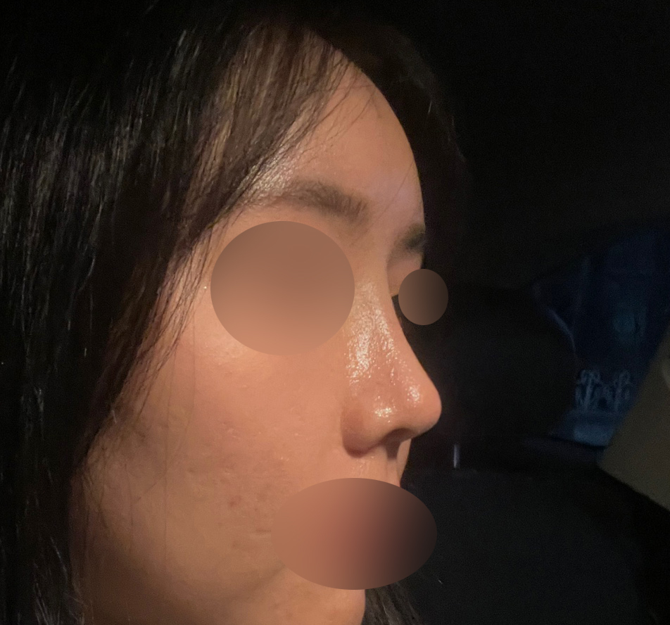 코하구 지방이식했습니다!