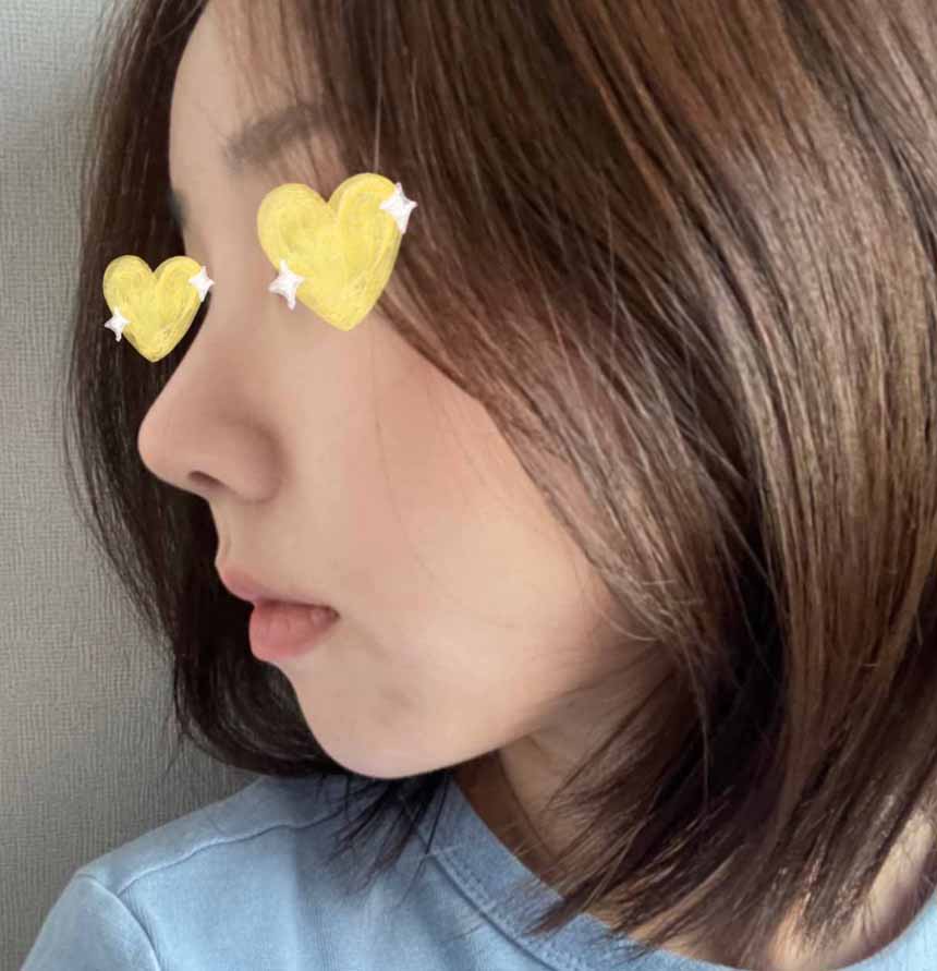 매부리코 무보형물로 수술~!!