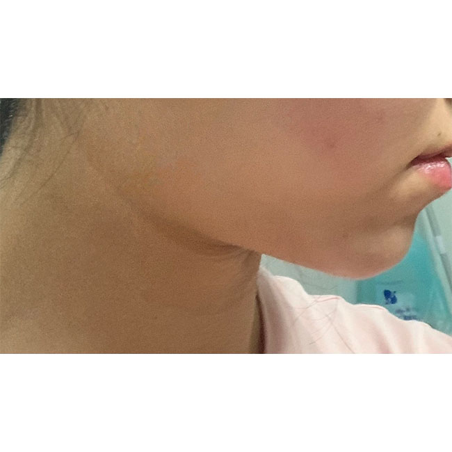 얼지흡으로 지방뿌신지 2개월차ㅋㅋ