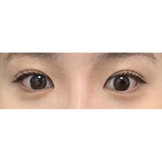부분절개눈매교정+앞트임 잘된거같아욥