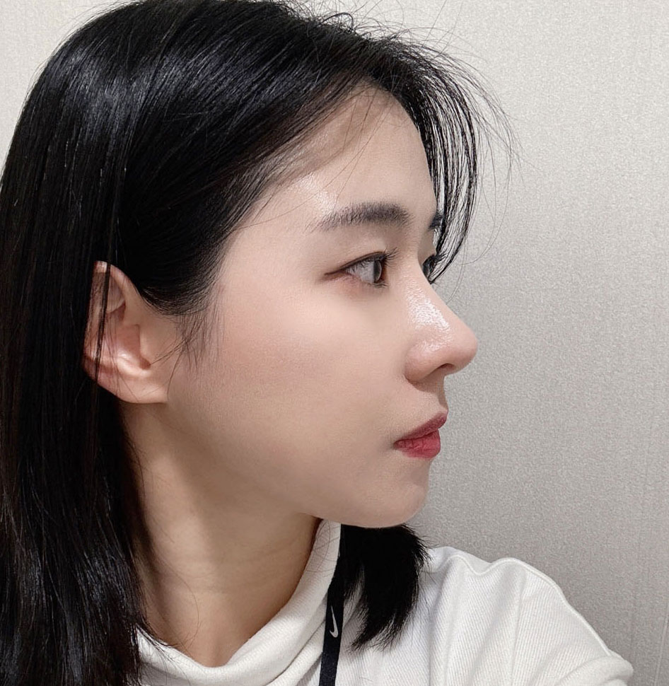 기능코수술 10개월차 대만족후기씁니당~~