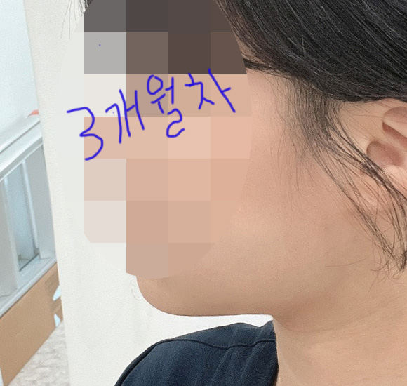 얼굴지방흡입 만족도 100프로!!