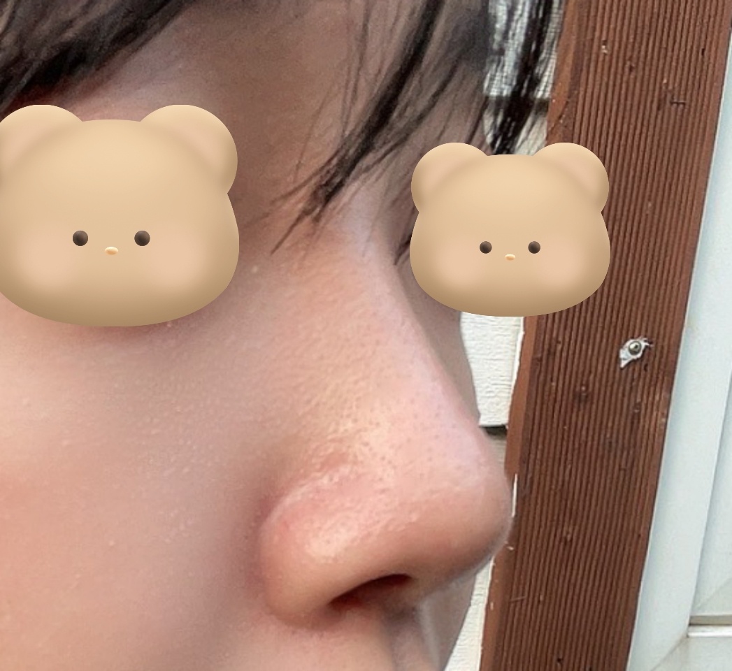 티안나면서 예쁘게 코성형됐습니당 ㅎㅎ