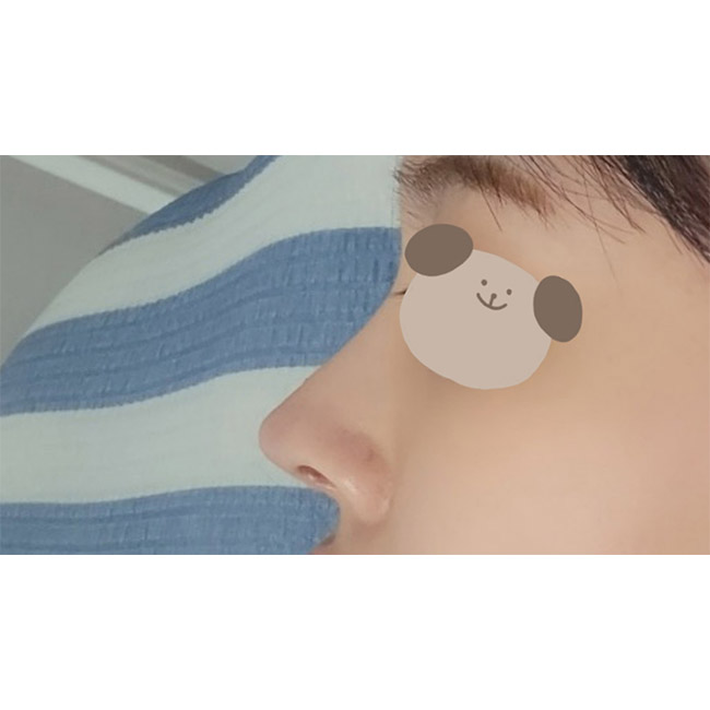 눈성형+코성형 넘넘 만족!!