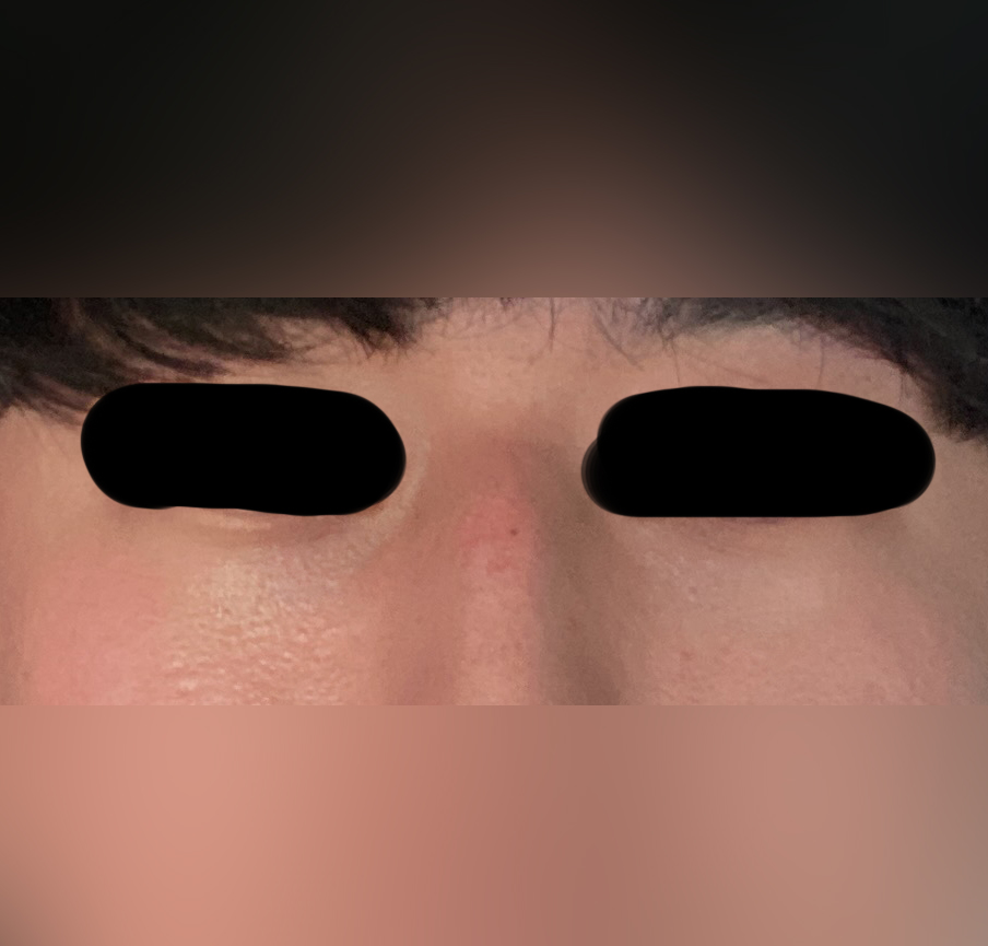 추천받고 바이브에서 눈밑성형한 후기