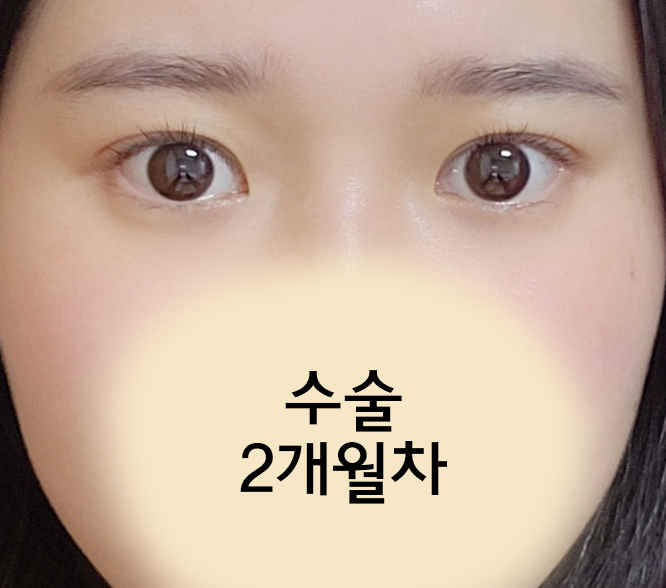 부분절개눈매교정 2개월차 전후비교!