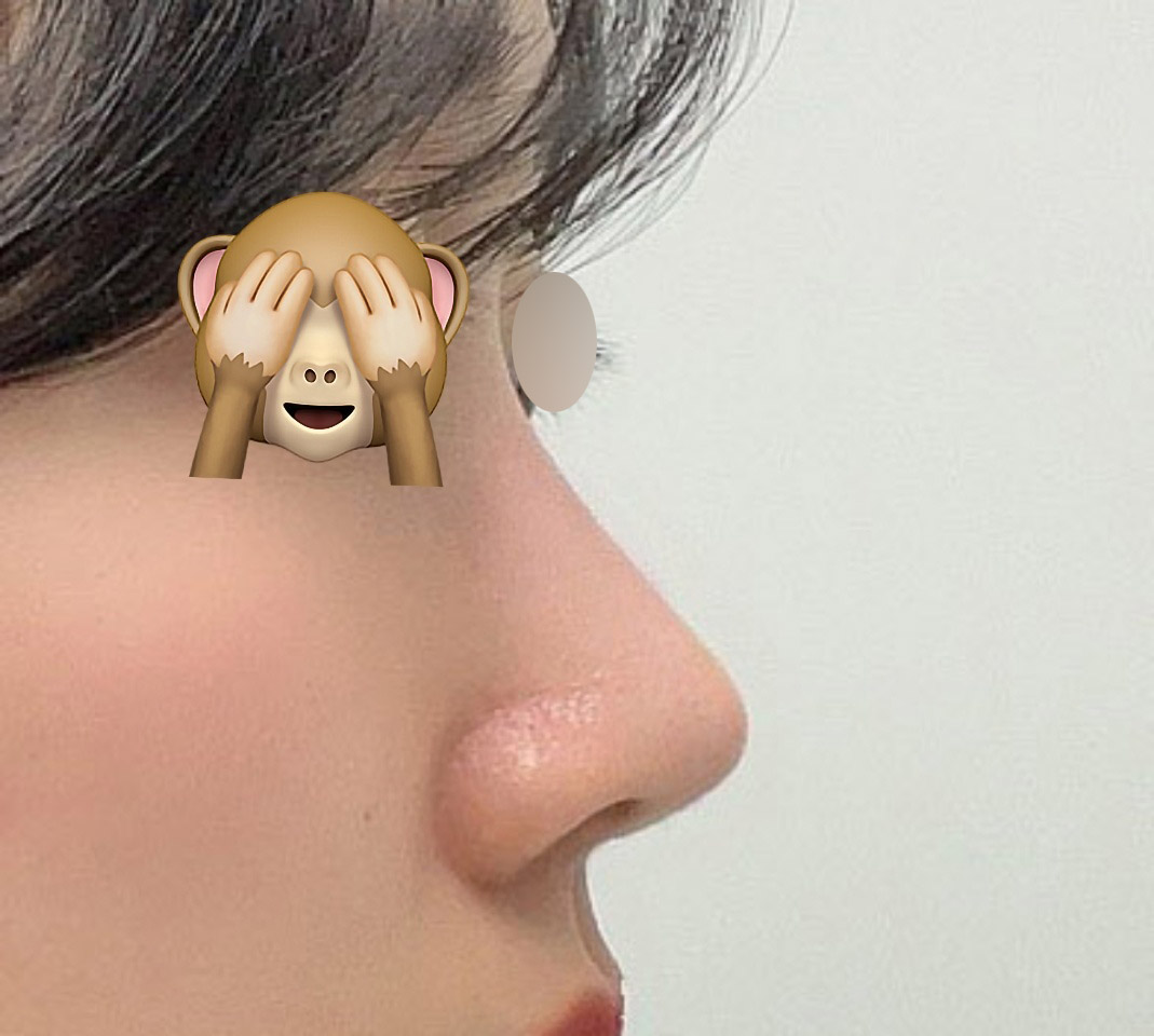 눈밑지방재배치+코성형 4개월차:)