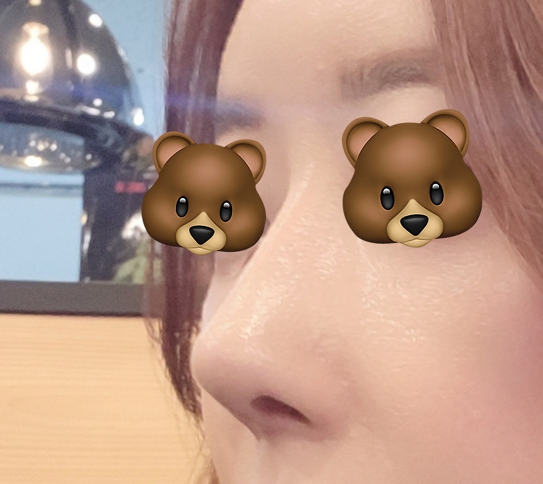 코재수술맛집이에요 역시ㅎㅎ